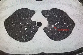 肺小结节到底切不切？医生提醒：不要让肺结节成为“心结”图片