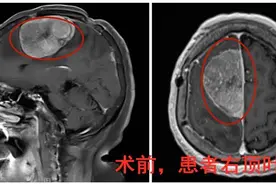 巨大脑瘤压顶，六旬婆婆险瘫痪图片