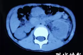 孩子跌了一跤，竟然摔破了肾脏图片
