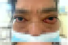 甲亢眼病危及视力，多学科协作保光明图片