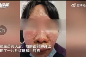 吃药犯一个错，女子肝脏衰竭进ICU！阳了千万别这么吃药，不救命反要命图片