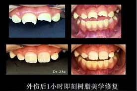 “以假乱真”的树脂美学修复术 山东大学齐鲁医院德州医院口腔科还您一口好牙图片