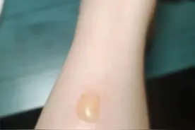 “暖宝宝”变皮肤杀手？冬季取暖警惕低温烫伤图片