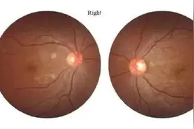 20岁女孩感染新冠3天后几近失明，确诊视网膜病变图片