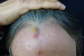 “阳”后这两类患者大增！有人疼痛剧烈，还有人耳朵里抽出积液图片