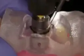 国家医保局：种一颗牙的整体费用，有望降低一半左右图片