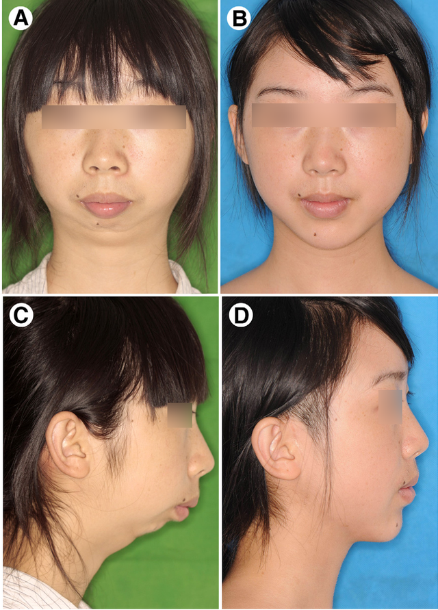 鼻梁高但下巴后缩是一种怎样的体验?