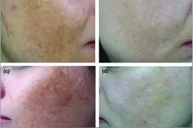 半胱胺，一种比氢醌还强效的美白剂，你还不知道？图片