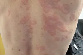 长沙男子“阳康”后全身长红斑瘙痒，医生：新冠后过敏的患者明显增加图片