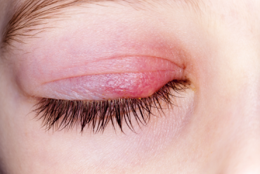 警惕!眼睛周围长了小疙瘩,千万别挤,小心与hpv病毒相关