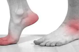 【健康科普】痛风科普40问图片