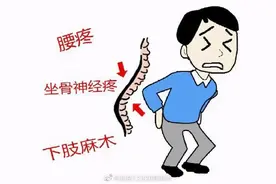 如何判断自己是否患了腰间盘突出？图片