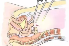 子宫肌瘤的手术方式有哪些？图片