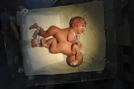 身体状况良好！湖南首对分离成功联体双胞胎快14岁了图片