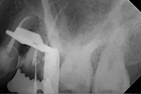 春节期间牙齿劈裂，济南市口腔医院一次性根管治疗加嵌体修复解决患者牙齿问题图片