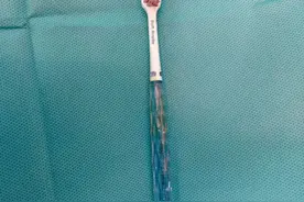 牙刷插舌 异物卡喉 医生教你如何正确处理“险情”图片