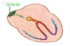 心脏起搏器科普知多少图片