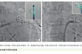 新型国产脉冲电场消融房颤，初步结果良好！阜外医院牛国栋等研究图片