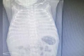 湖南一早产新生儿出现白肺，治疗3天后好转，专家紧急提醒！图片