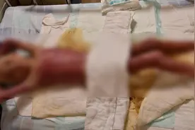 6岁男孩帮瘫痪爸爸做饭被重度烧伤：长大想当医生，让爸爸站起来图片