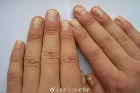 指甲的哪些变化需警惕疾病风险？图片