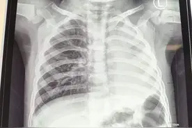 硬币、戒指、吸管、螺丝钉……“吞金兽“们吞下的异物五花八门，专家提醒家长应做好防护图片