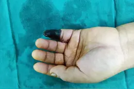 做饭割伤手指，自行包扎一周未松绑，女子痛失半截手指图片