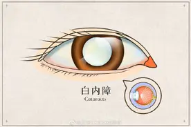 白内障手术后注意事项图片