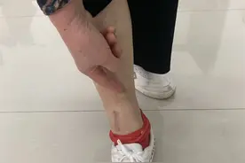 南宁一女子踩空井盖摔致伤残，维权近5年无果，11名被告均称不该担责图片