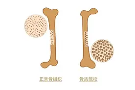 骨质疏松易骨折，严重可致命！这4种微量元素你补了吗？图片