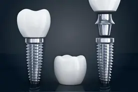 多地下调种植牙服务费，集采后种一颗牙或将节省9000元图片