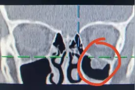 厦门5岁男童摔一跤没在意，家长后悔死了……医生：极易漏诊图片