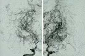 39岁老师突然说不清话，还常常对同事翻白眼，一查竟是……图片