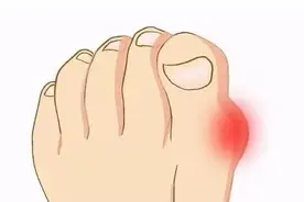10大常见误区解读！痛风被称为暗藏的“健康杀手”图片