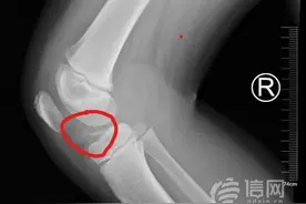 6岁女孩受伤膝关节肿胀原是骨折 妇儿专家提醒及时就诊图片
