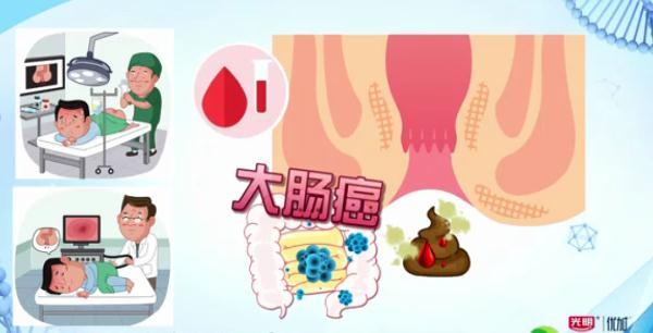 大便出血……是痔疮还是癌症？简单几点，教你辨别！