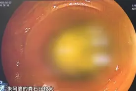 74岁阿婆腹痛难忍，医生“开处方”让她喝3天可乐图片
