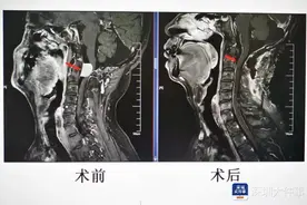 男子颈椎里长瘤，不切除可能瘫痪，深圳医生用“超声刀”切除图片