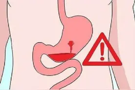 消化道出血有什么表现？如何预防？图片