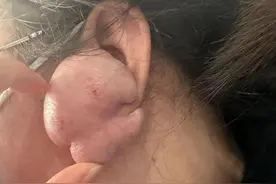 27岁姑娘打个小小耳洞却惹祸上身，耳朵长出鸡蛋大小肉疙瘩图片