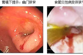 八旬老翁患三处消化道梗阻疾病 胃肠外科克服险难成功手术图片