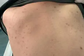 小伙关节痛7年竟是患有罕见病，专家：临床症状极具迷惑性，尽早识别图片
