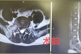 右腿剧痛下不了床，腰椎间盘突出了！做手术or保守治疗？骨科医生这样说……图片