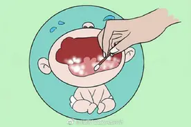 如何治疗婴幼儿鹅口疮？图片