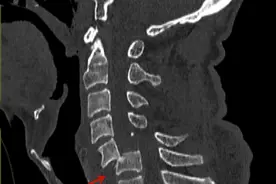 兰大二院急诊外科成功救治一例颈椎骨折并完全脱位患者图片