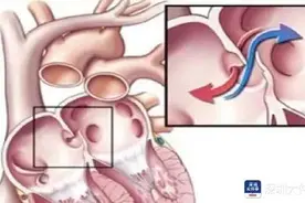 上班时突然头晕、手脚麻木，女子查出脑梗！原因并不罕见……图片