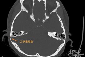 “咚咚咚”，连续3年听到自己“怦然心动”的声音，细查竟是一种少见病图