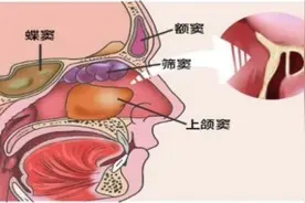 鼻窦炎为何经常就诊于神经内科-鼻源性头痛：鼻窦炎图片