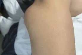 男子全身关节长满密密麻麻的“石头”，专家：他这个习惯很多人都有图片