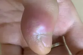 差点把手指“啃”没了！少年嗜“吃手”引发急性骨髓炎图片